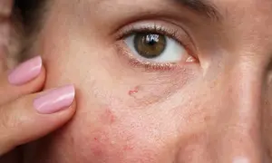 Nerwica naczyniowa skóry twarzy objawy: poznaj niepokojące symptomy