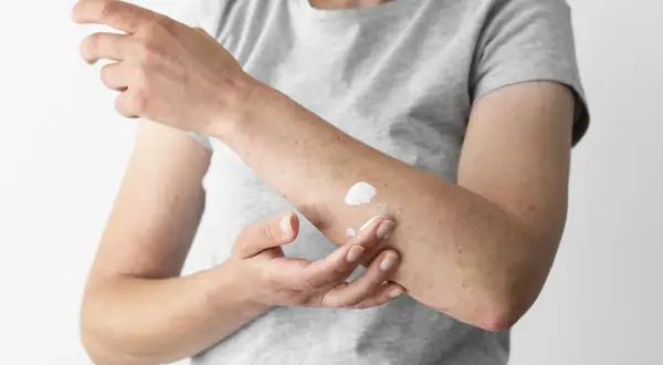 Łuszczyca: preparaty dostępne bez recepty – co naprawdę działa?