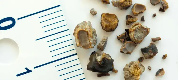 Zdjęcie Jakie leki na kamienie w nerkach mogą przynieść ulgę i pomóc?